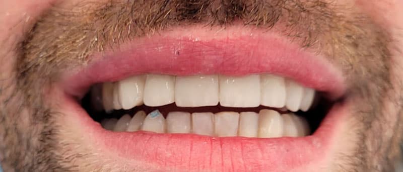 Estética Dental