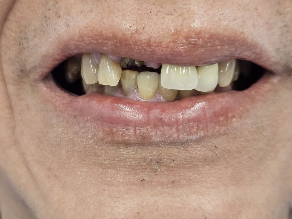 Implantes — caso real — antes