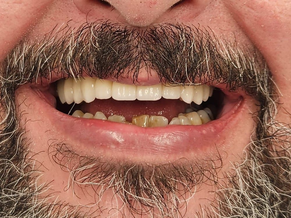 Implantes — caso real — antes
