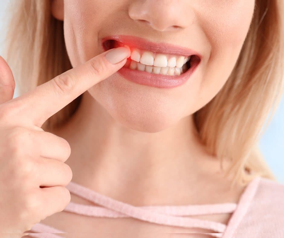 ¿Qué es la Gingivitis y Cómo Tratarla en Clínica Dr. Bonastre Dentistas Ontinyent?