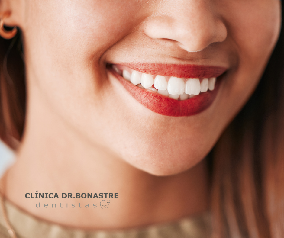 Carillas dentales Mejora tu sonrisa con esta solución estética